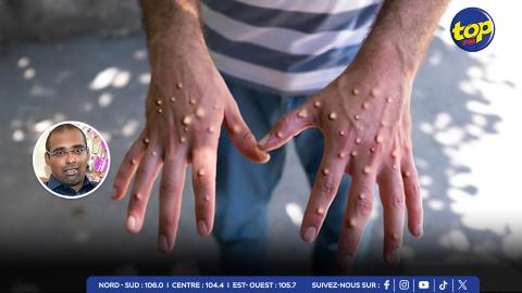 Mpox :