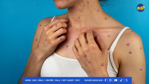 Mpox ou variole du-singe