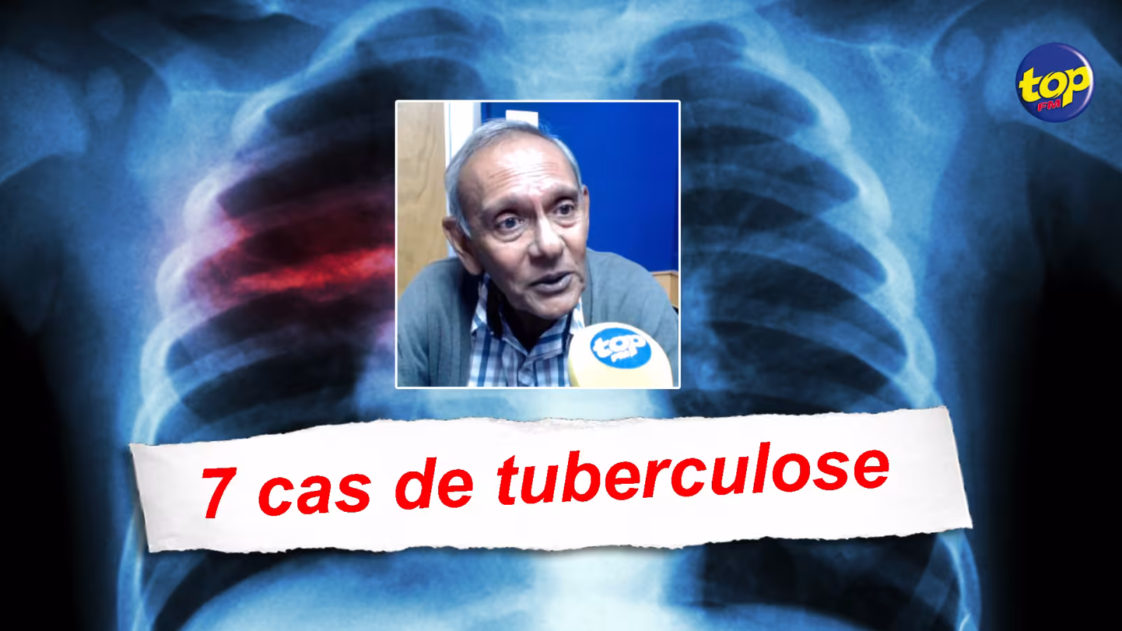 Sept cas de tuberculose dans le pays : “Même si la situation est sous contrôle, c’est une affaire  à prendre au sérieux.” Conseille le Dr Karam Chandra Ramyead, pneumologue