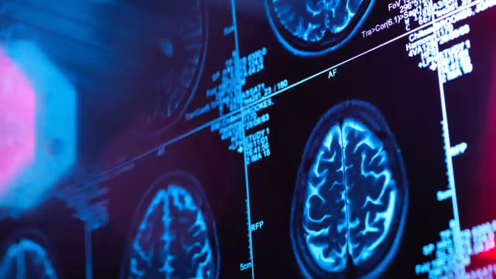 Enfin :  un médicament contre Alzheimer pour ralentir légèrement la maladie