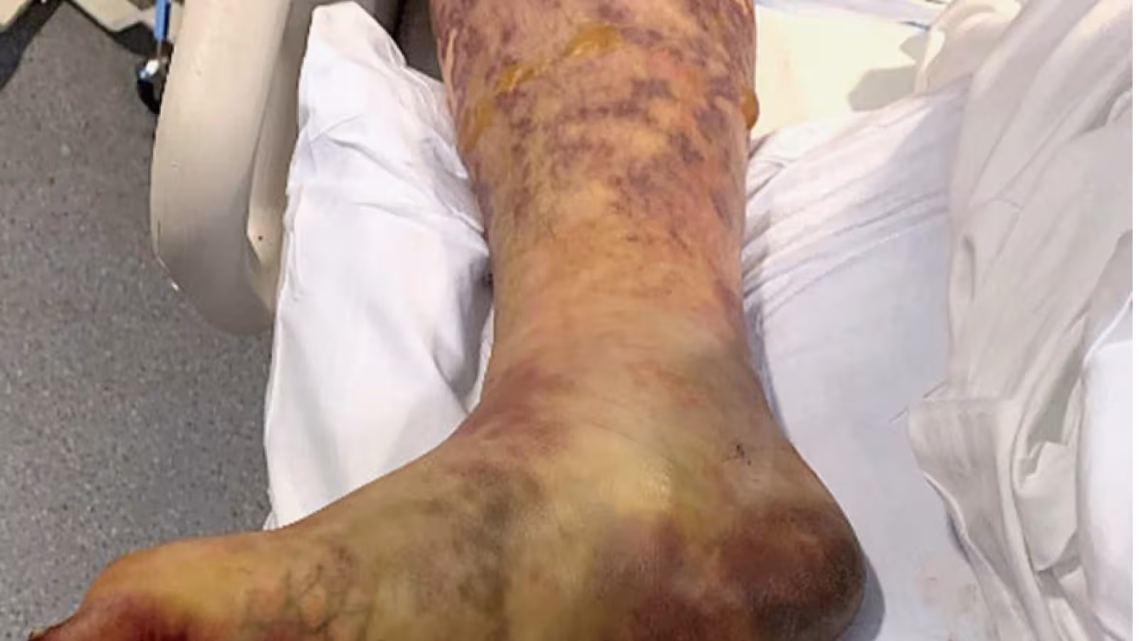 Il mange les restants d’un ami : On lui ampute pieds et doigts pour sauver sa vie