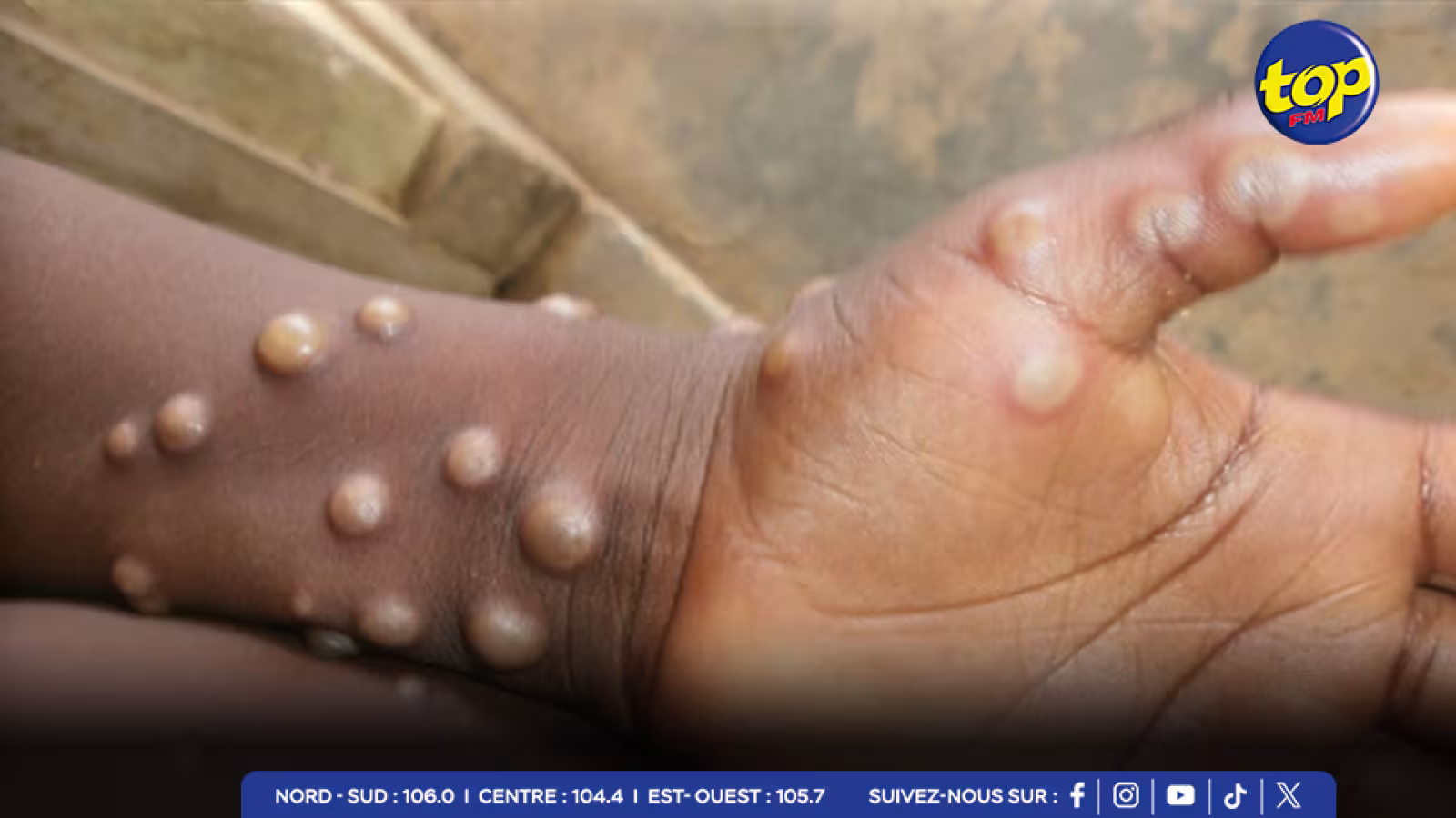 L’'épidémie de mpox s’aggrave en République démocratique du Congo :