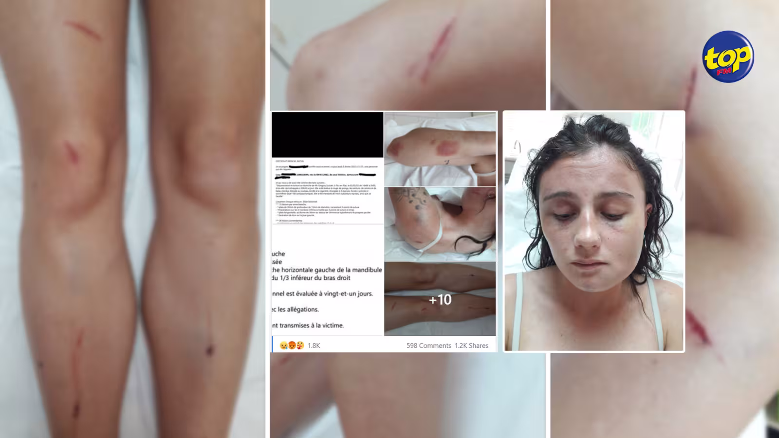 Séquestration et agression sauvage à Flic en Flac : une jeune femme de 19 ans raconte sa nuit d’horreur aux mains de son ex-copain