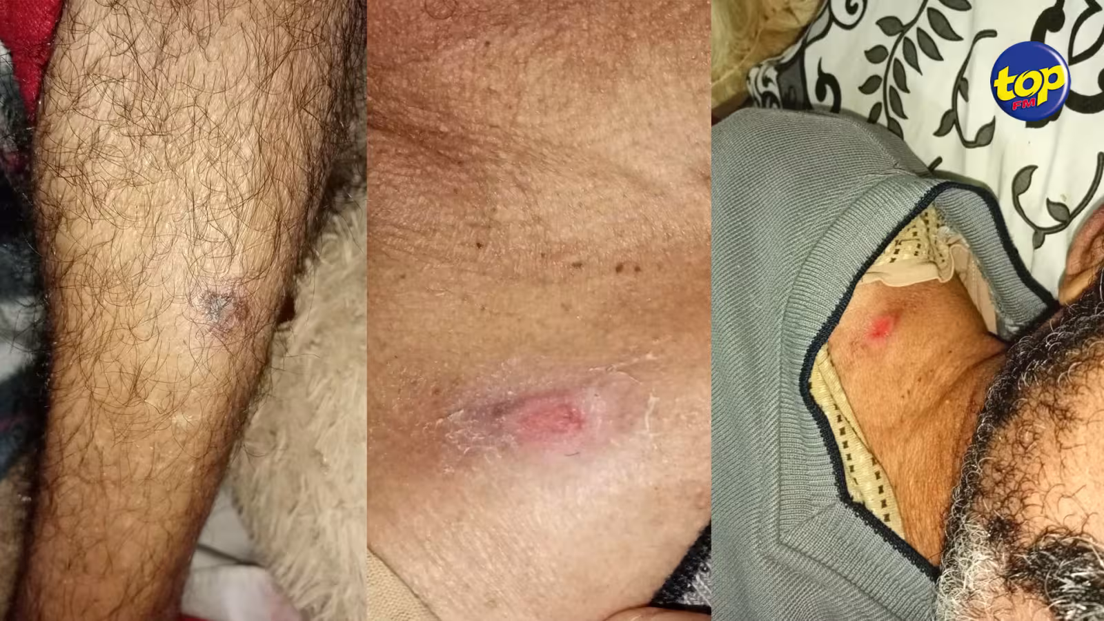 À l’hôpital Bruno Cheong à Flacq : la famille d’un homme de 66 ans, souffrant d’un handicap sévère, porte plainte pour maltraitance et négligence alléguées