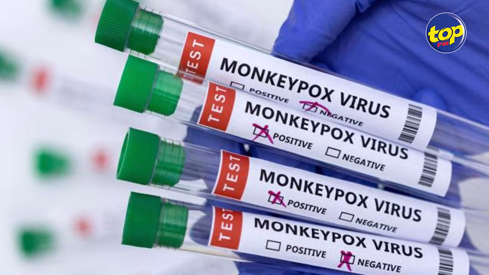 Variole du singe : Trois cas suspects en isolement dans un hôpital régional à Maurice
