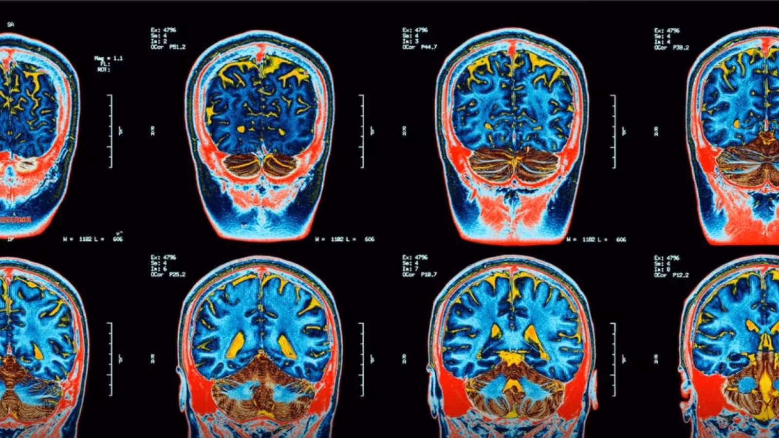 Un trouble cérébral hallucinant et mystérieux a infecté un groupe au Canada