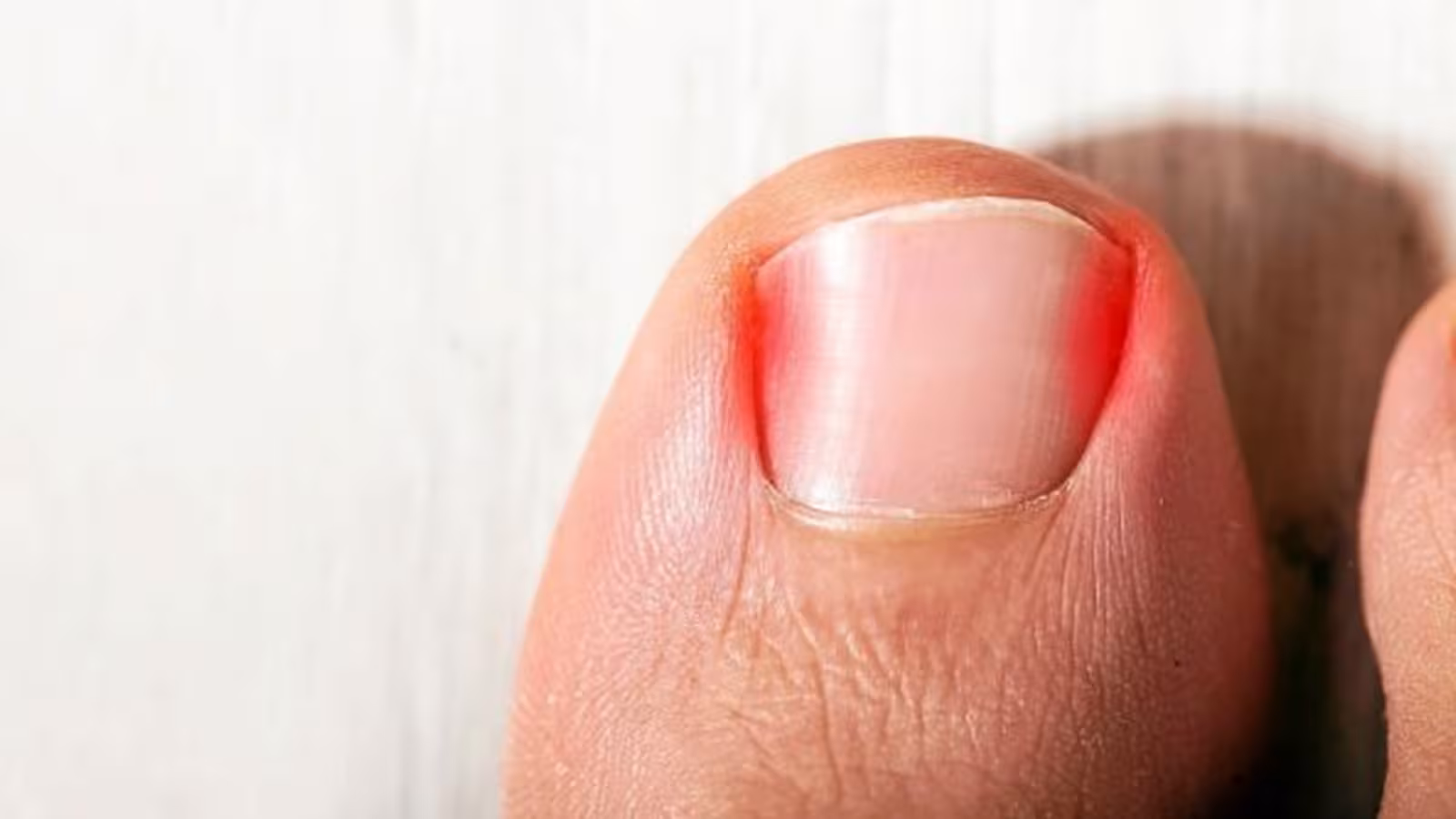 Astuces pour eviter les ongles incarnés