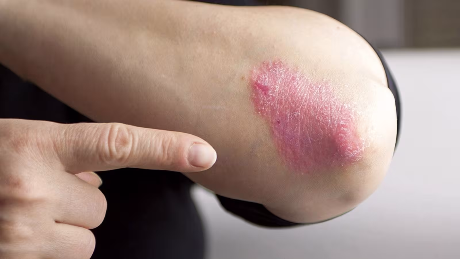 Journée Mondiale du psoriasis