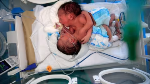 Yémen : dans un état critique, deux bébés siamois attendent une opération à l’étranger
