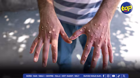 MPOX