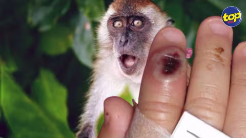 Variole du singe : une maladie qui n’est pas nouvelle mais qui a longtemps été sous-estimée