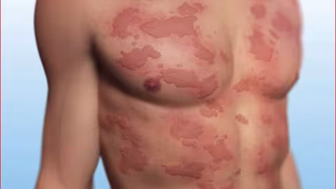 Forte allergie au vaccin Pfizer : une infirmière se retrouve aux urgences