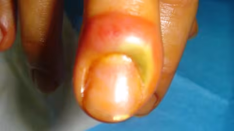 Les bons gestes à adopter en cas de panaris