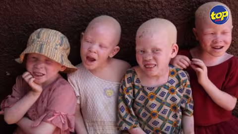 Région : les enlèvements d’albinos se multiplient Madagascar