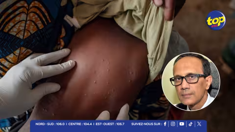 MPOX : Les autorités mauriciennes durcissent les mesures sanitaires face à la situation à Madagascar