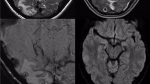 Une Australienne souffrant de migraines découvre des larves dans son cerveau